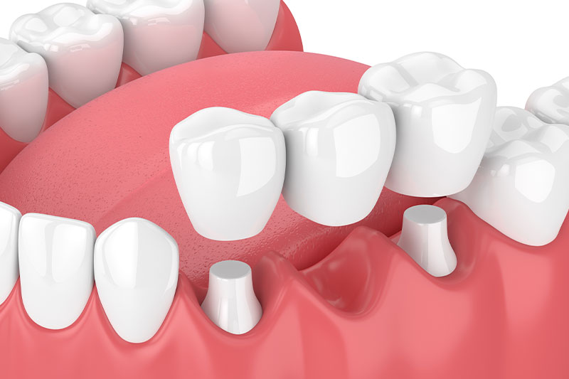 Dental Bridges in South Austin