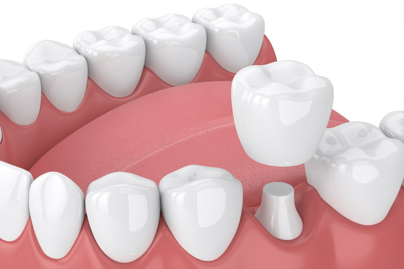 Dental Crowns in South Austin
