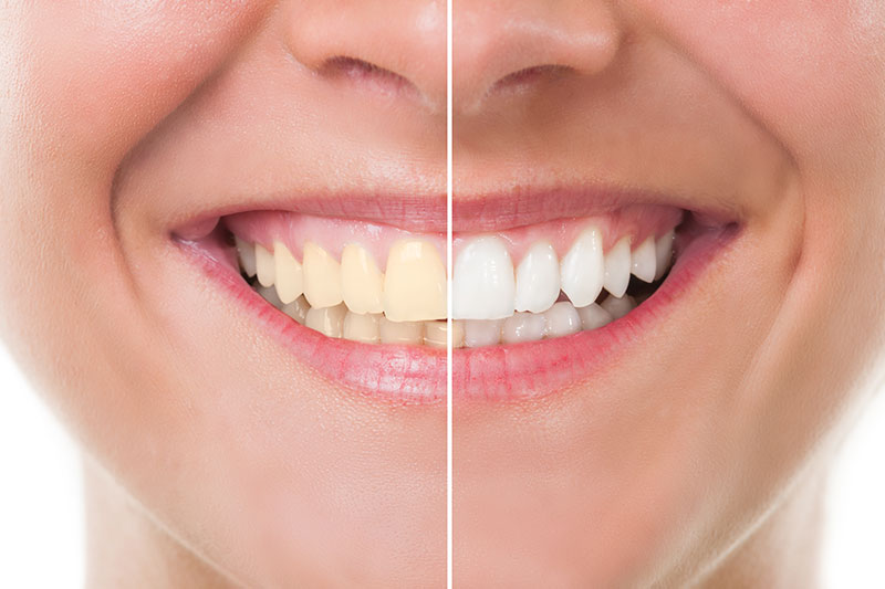 Teeth Whitening in South Austin