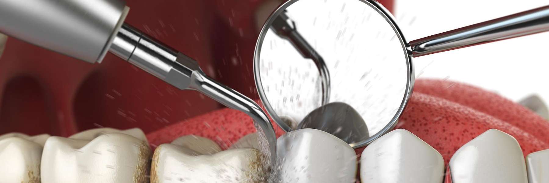 Routine Dental Scaling and Polishing