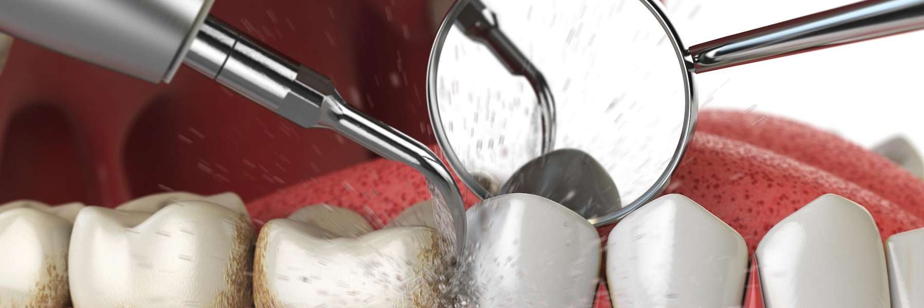 Routine Dental Scaling and Polishing