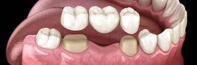 Diagram of dental bridges