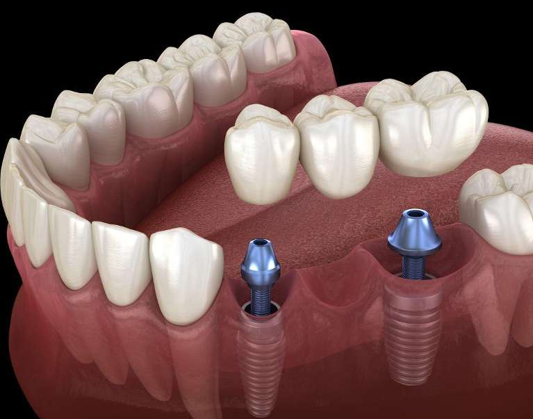 dental bridge diagram, south austin tx