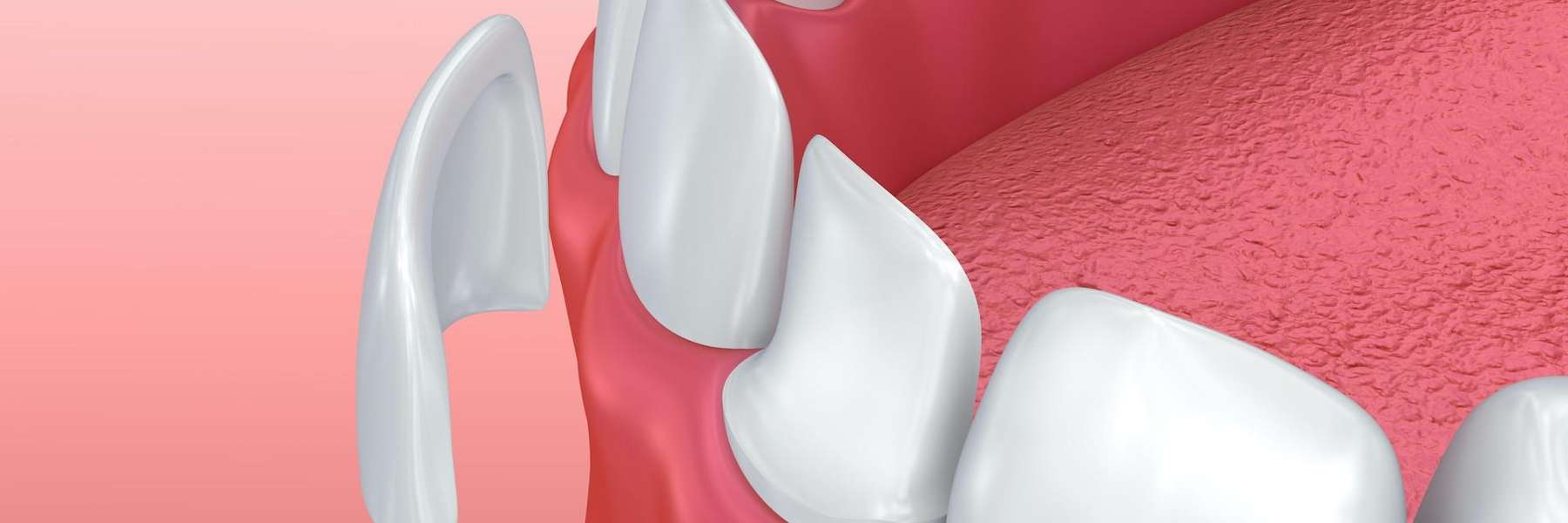 Image of veneer being placed on a tooth, south austin tx