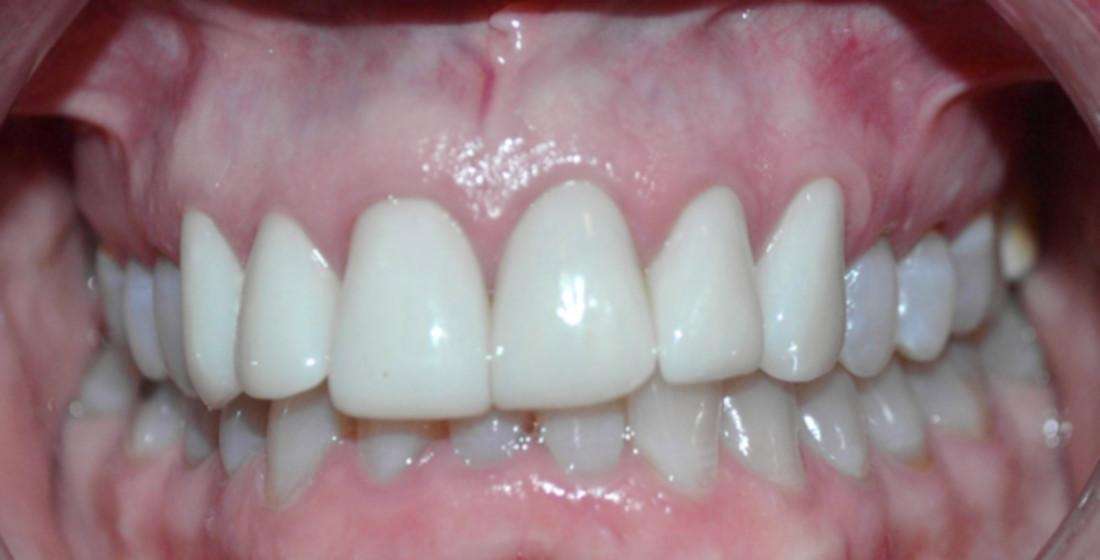 Patient who got dental veneers in South Austin, TX
