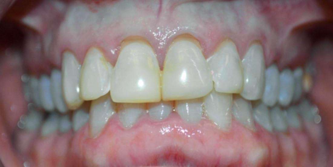 Patient with a tooth gap in South Austin, TX