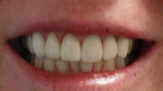 Regain-Confidence-With-Dental-Crowns-After-Image