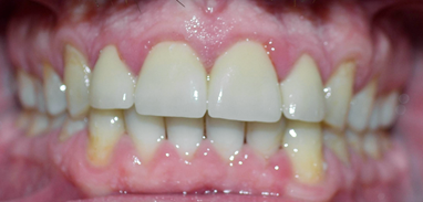 Reconstruct-Your-Smile-With-Porcelain-Veneers-After-Image