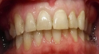 Regain-Confidence-With-Dental-Crowns-Before-Image