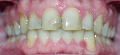 Reconstruct-Your-Smile-With-Porcelain-Veneers-Before-Image