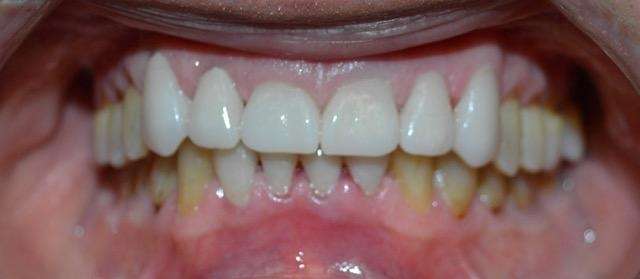 Complete-Your-Smile-With-Dental-Crowns-After-Image