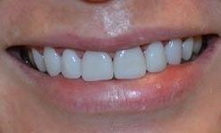 smile after crowns and veneers, south austin tx