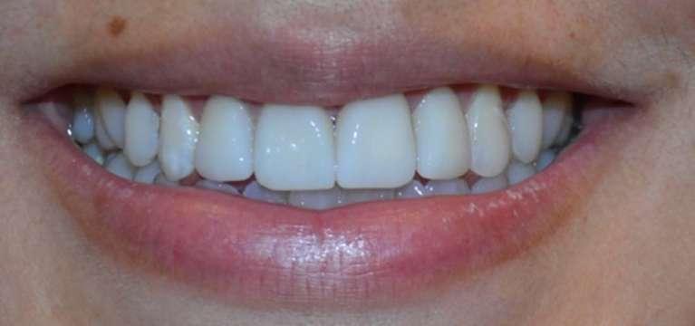 Patient after receiving veneers in South Austin TX