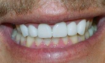 Complete-Your-Smile-With-Porcelain-Veneers-After-Image
