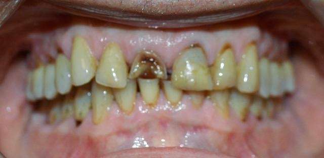 Complete-Your-Smile-With-Dental-Crowns-Before-Image