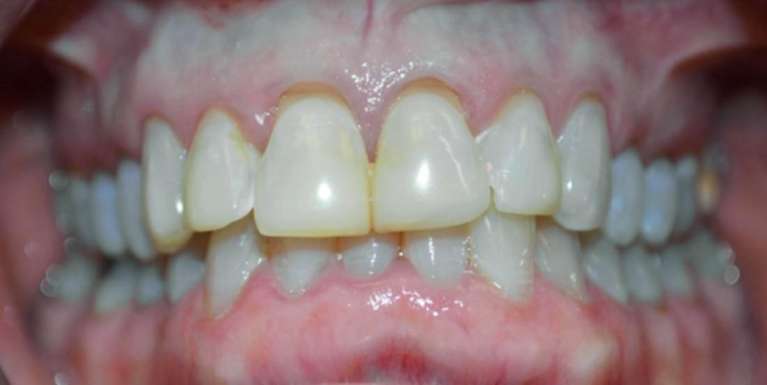 Patient with a tooth gap in South Austin, TX