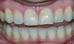 dicolored teeth before crowns and veneers, south austin tx