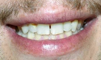 Complete-Your-Smile-With-Porcelain-Veneers-Before-Image