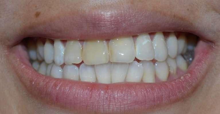 Patient with tooth wear and discoloration, South Austin